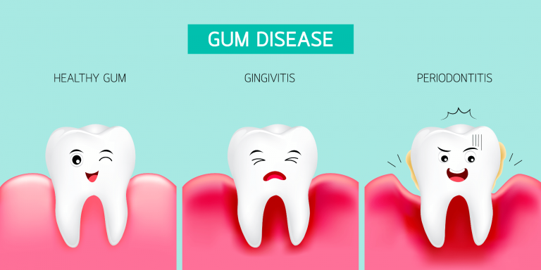 Gingivitis - inflammation of the gums