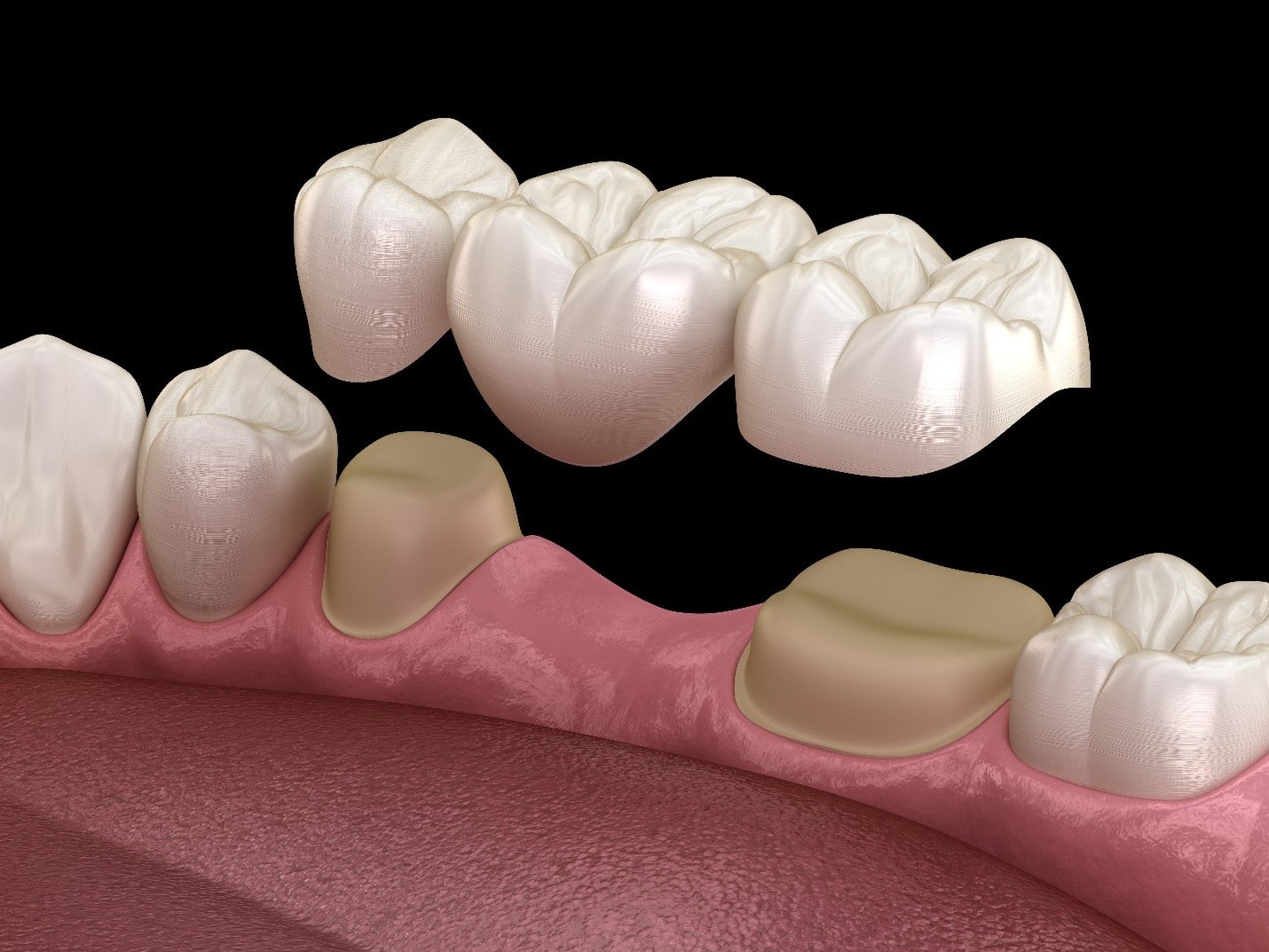 Dental Bridges Dentist Christchurch Pathway Dentists
