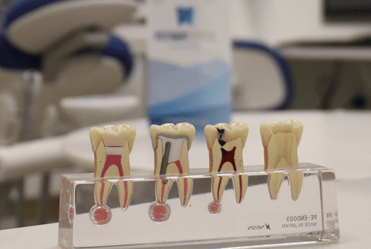 Services-Root-Canal-Therapy-min