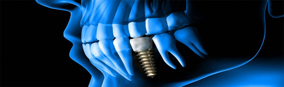 Dental Implant - Defining Key Terms