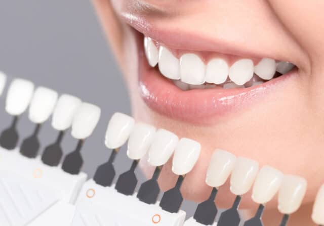 Professional Teeth Whitening