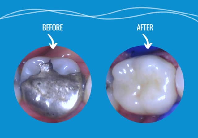 Pathway Dental Cerec Crown In A Day - Before & After